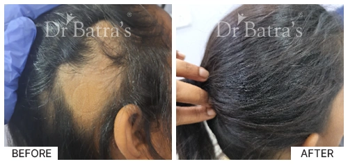 Hair Falling Treatment